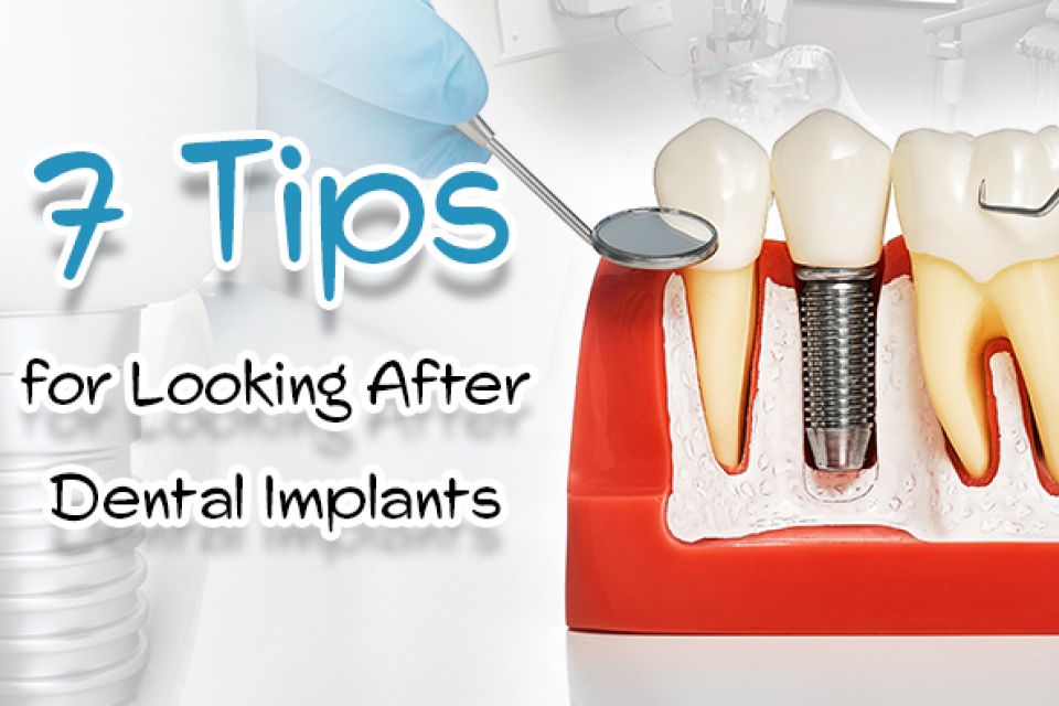 7 Tips for Looking After Your Implants