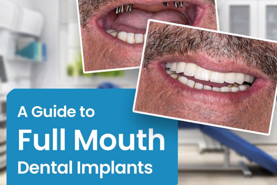 A Comprehensive Guide to Full Mouth Dental Implants