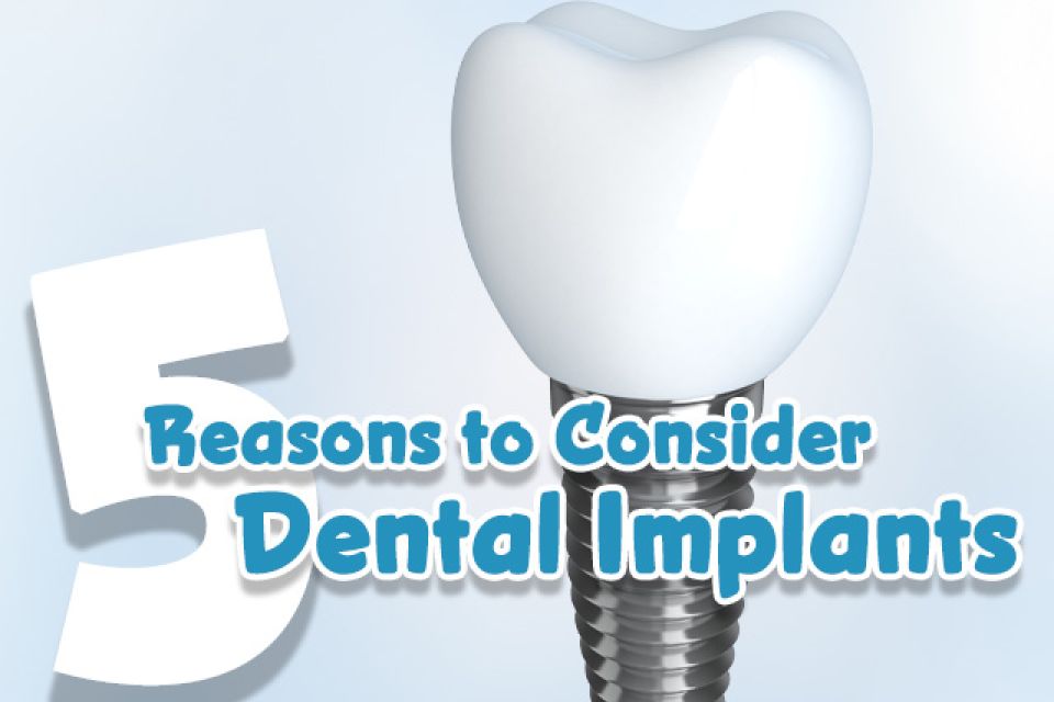 5 Reasons Why You Should Consider Dental Implants in California
