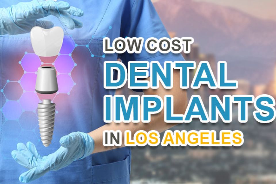 Low Cost Dental Implants Near Me in Los Angeles